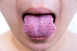 Ayurveda Many cracks on tongue Example 1