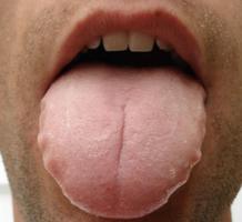 Ayurveda Teeth marks on tongue edges Example 1
