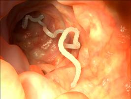 Ayurveda Intestinal Worms / Parasites / Protozoa / Bacteria Example 1